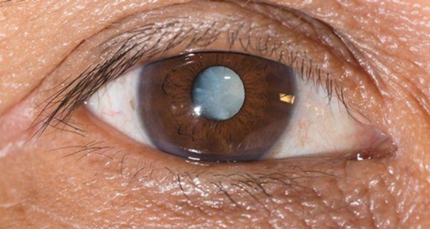 mắt sáng khỏe, khám mắt ngôi sao, mắt sáng, Bệnh Glaucoma