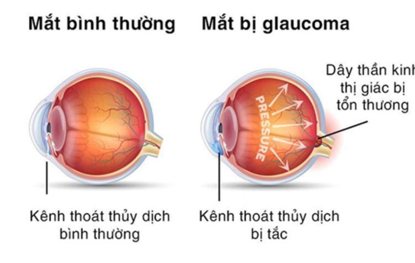 mắt sáng khỏe, khám mắt ngôi sao, mắt sáng