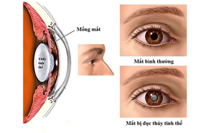 mắt sáng khỏe, khám mắt ngôi sao, mắt sáng