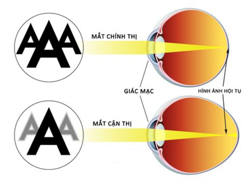 đo độ cận thị