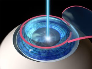 Phẫu thuật LASIK