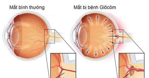 Bệnh Glôcôm