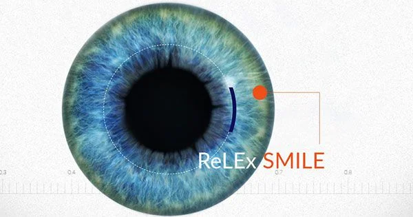 phẫu thuật Relex Smile