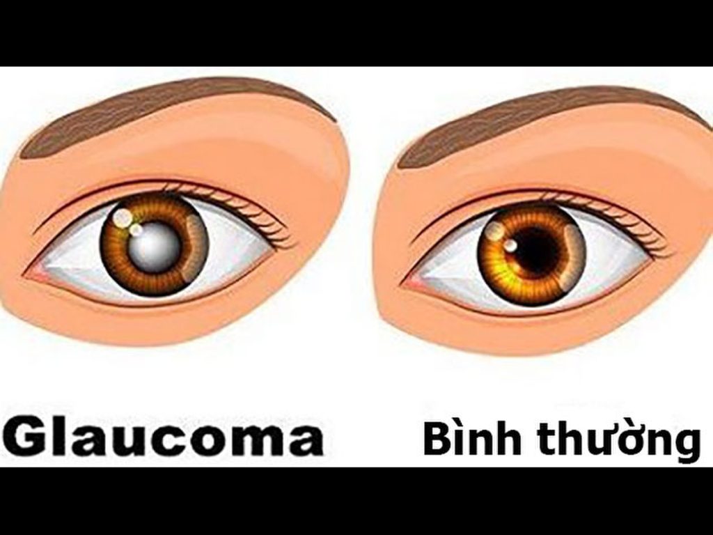 Bệnh glaucoma (cườm nước)