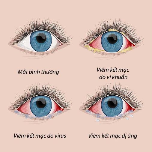 xử lý viêm kết mạc dị ứng