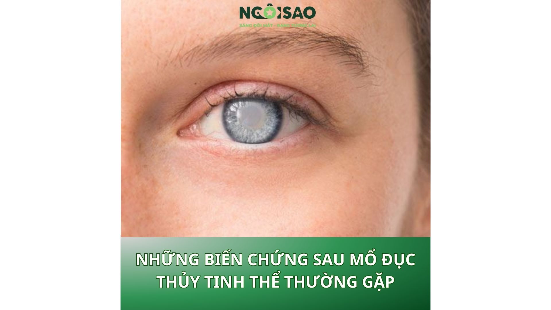 biến chứng sau mổ đục thủy tinh thể