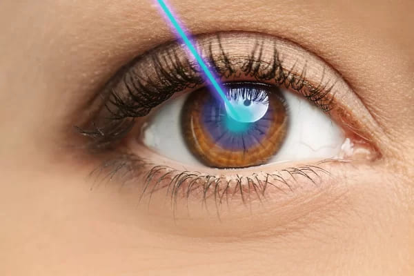 Phẫu thuật Lasik