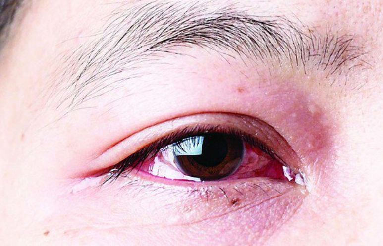 glaucoma góc mở và đóng