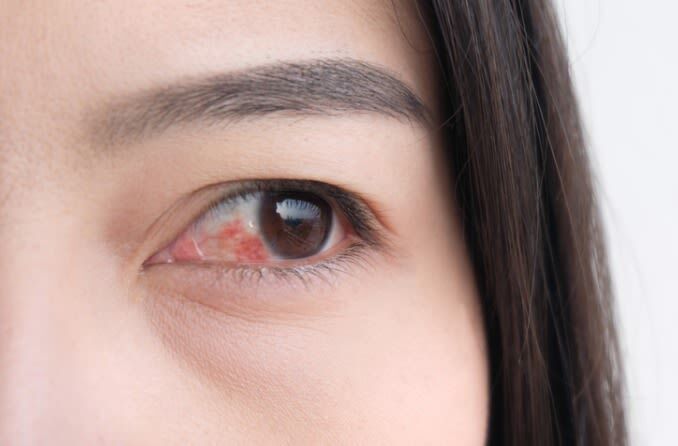 Khô rát mắt hậu phẫu LASIK