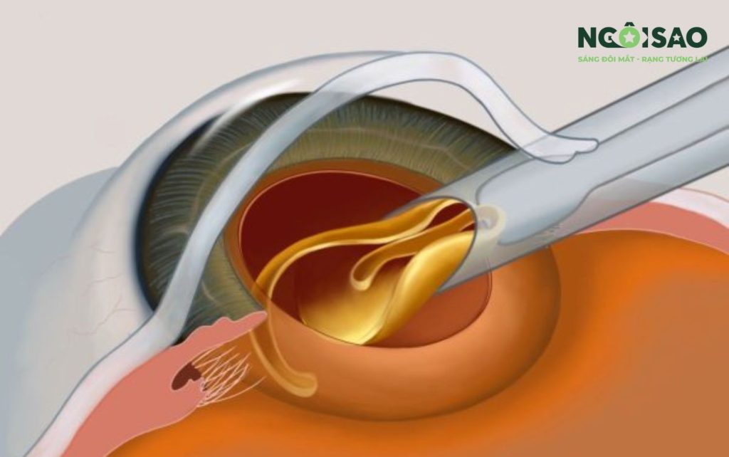 Mắt mờ hậu phẫu Phaco